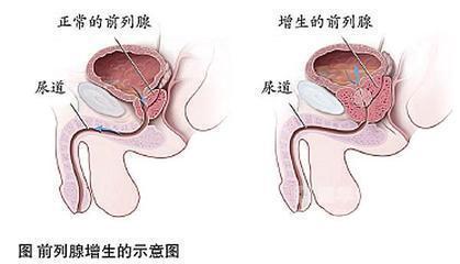 按摩前列腺的方法，了解、實踐與注意事項，按摩前列腺，方法、實踐與注意事項全解析